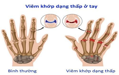 Truyền thông - Triệu chứng viêm khớp dạng thấp 