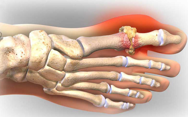 Truyền thông - Bật mí một số cách trị bệnh gout an toàn