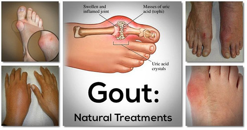 Truyền thông - Bệnh gout có nguy hiểm không? Cách phòng tránh biến chứng hiệu quả