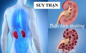 Truyền thông - Cảnh báo nguy cơ suy thận cao với những dấu hiệu thường thấy