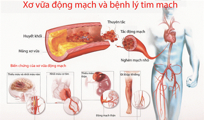 Truyền thông - Phòng tránh xơ vữa động mạch bằng đông trùng hạ thảo (Hình 2).