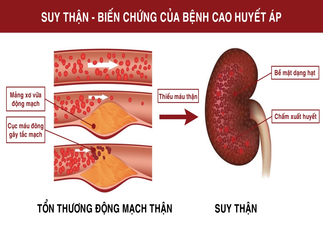 Truyền thông - Huyết áp cao và nguy cơ gây biến chứng suy thận (Hình 2).