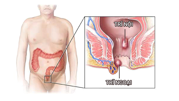 Truyền thông - Bệnh trĩ và những điều cần biết