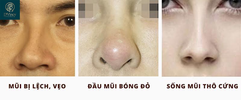 Truyền thông - Lựa chọn chất liệu nâng mũi như thế nào để hạn chế biến chứng?