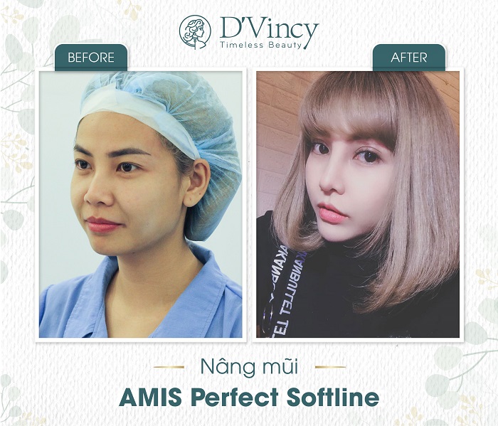 Truyền thông - Lựa chọn chất liệu nâng mũi như thế nào để hạn chế biến chứng? (Hình 3).