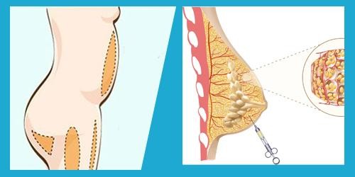 Truyền thông - Bạn hiểu gì về công nghệ nâng ngực bằng mỡ tự thân?