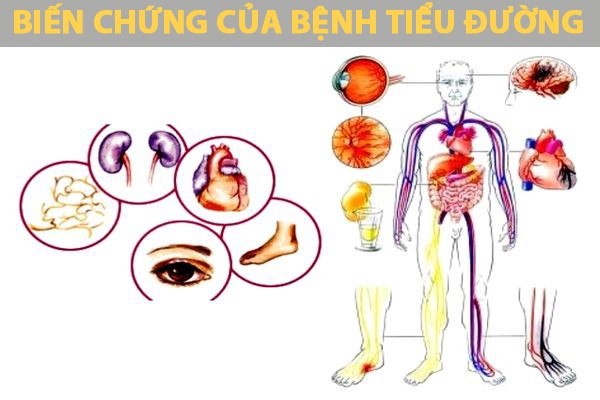 Truyền thông - Các nguyên nhân gây bệnh tiểu đường thường gặp