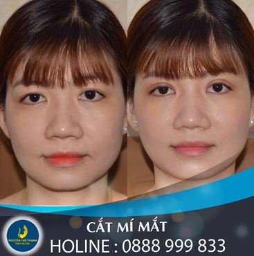 Truyền thông - Cắt mí mắt nên hay không? (Hình 2).