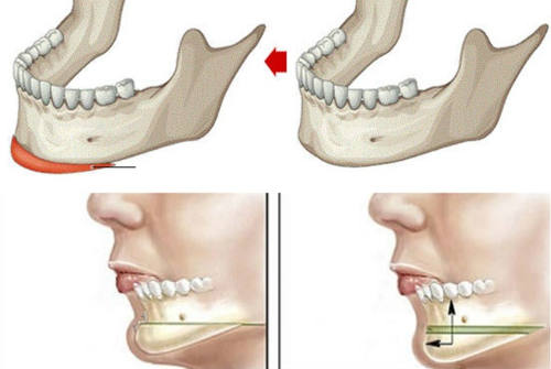 Truyền thông - Độn cằm V-Line có được vĩnh viễn không? (Hình 2).