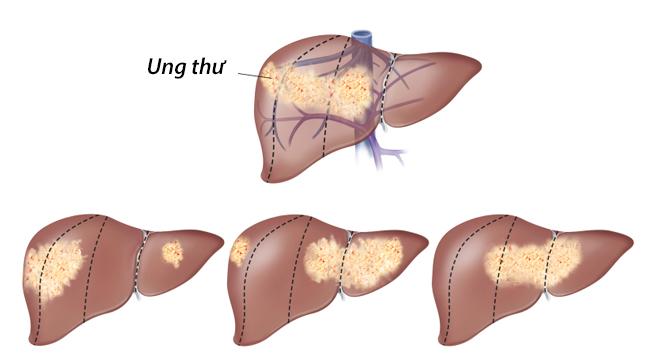 Truyền thông - Bệnh ung thư gan sống được bao lâu?