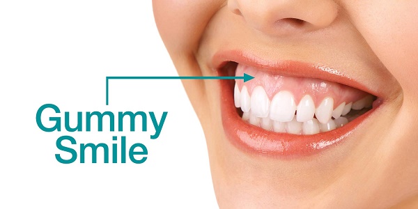 Thương hiệu - Điều trị cười hở lợi: Giải pháp cho nụ cười hoàn hảo từ San Dentist 