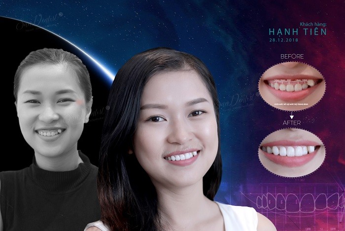 Thương hiệu - Điều trị cười hở lợi: Giải pháp cho nụ cười hoàn hảo từ San Dentist  (Hình 2).