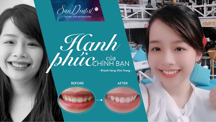 Thương hiệu - Điều trị cười hở lợi: Giải pháp cho nụ cười hoàn hảo từ San Dentist  (Hình 3).