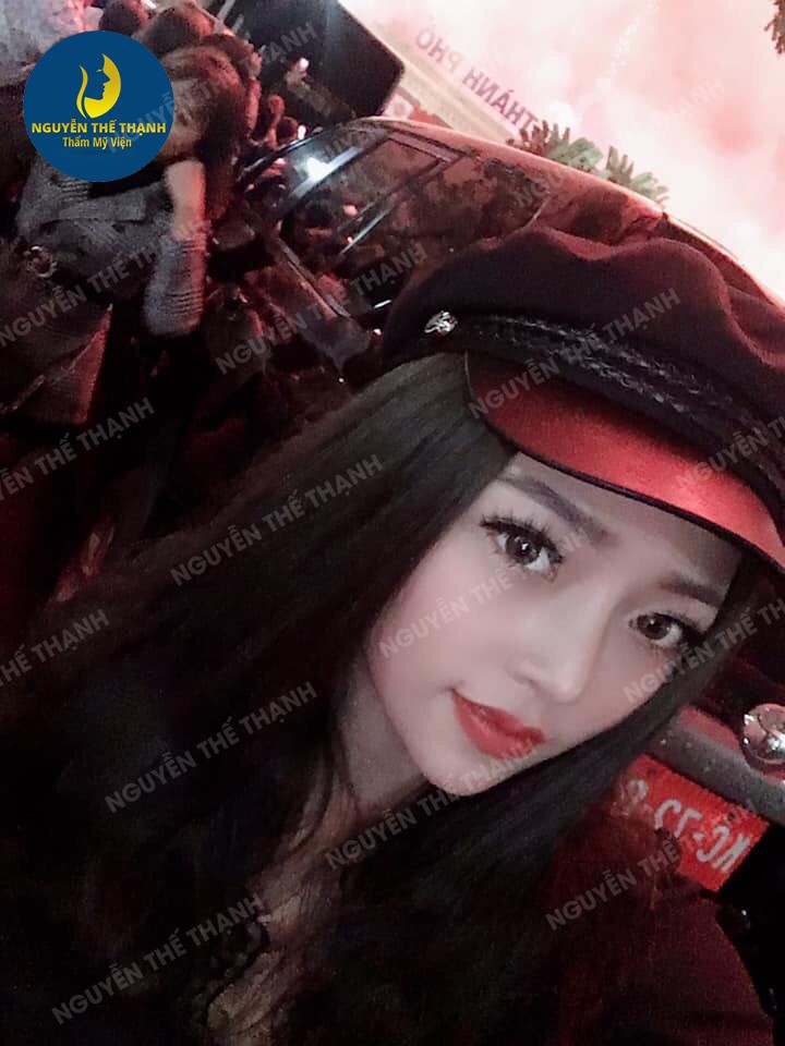 Truyền thông - Nâng mũi bọc sụn là như thế nào? (Hình 5).