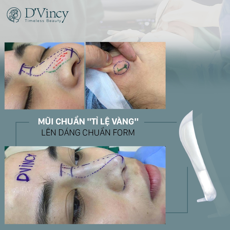 Thương hiệu - “Giải mã” công nghệ Amis trong nâng mũi cấu trúc tại D’Vincy
