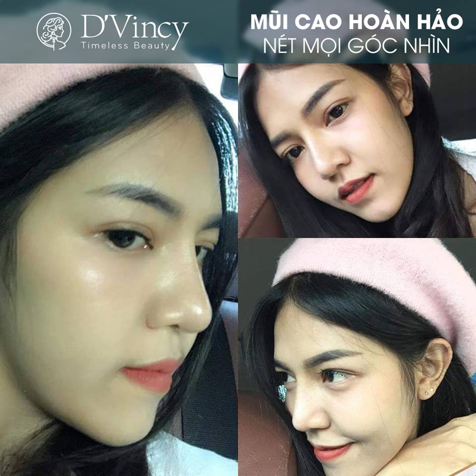 Thương hiệu - “Giải mã” công nghệ Amis trong nâng mũi cấu trúc tại D’Vincy (Hình 3).