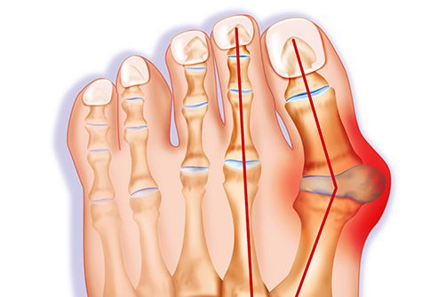 Truyền thông - Bệnh gút nguy hiểm như thế nào?