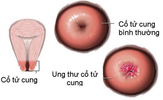 Truyền thông - Những loại ung thư nào cần đi khám tầm soát ung thư sớm? (Hình 2).