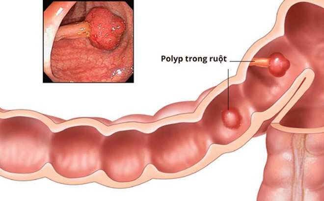 Truyền thông - Các biện pháp phòng tránh ung thư đại tràng 