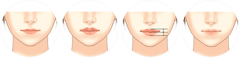 Truyền thông - Phẫu thuật thu mỏng môi – Môi xinh quyến rũ (Hình 2).