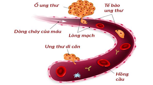 Truyền thông - Dấu hiệu nhận biết của từng loại ung thư phổi di căn 