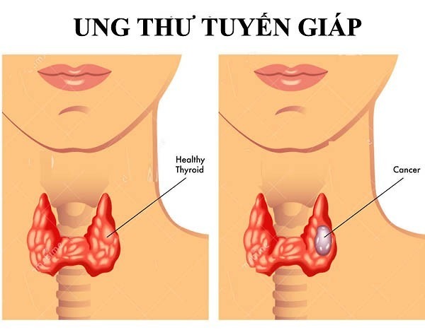 Truyền thông - 5 câu hỏi thường gặp nhất về bệnh ung thư tuyến giáp