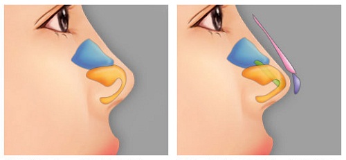 Truyền thông - Những điều cần biết về nâng mũi bằng sụn tự thân (Hình 2).