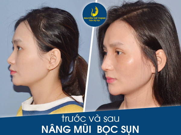 Truyền thông - Những điều cần biết về nâng mũi bằng sụn tự thân (Hình 3).