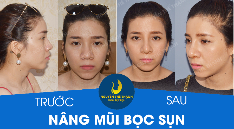 Truyền thông - Những điều cần biết về nâng mũi bằng sụn tự thân (Hình 4).