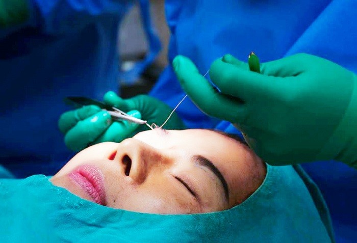 Truyền thông - Theo chân khách hàng đến Viện thẩm mỹ D’vincy sửa mí hỏng (Hình 2).