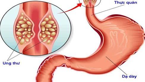 Truyền thông - Bất ngờ với những nguyên nhân gây bệnh ung thư thực quản