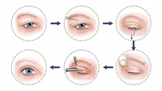 Cần biết - Nên lựa chọn cắt mí mắt hay bấm mí mắt (Hình 4).