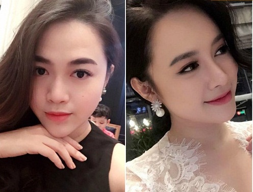 Cần biết - Nâng mũi sụn tự thân: Thực hư về phương pháp giúp tăng tuổi thọ của dáng mũi (Hình 5).