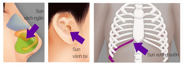 Cần biết - Nâng mũi sụn tự thân: Thực hư về phương pháp giúp tăng tuổi thọ của dáng mũi