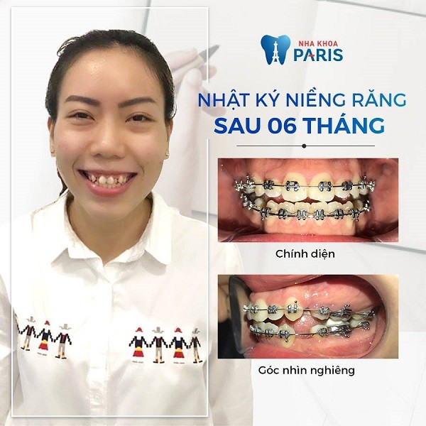 Cần biết - Hàm răng xấu đang hủy hoại tương lai của bạn như thế nào? (Hình 4).