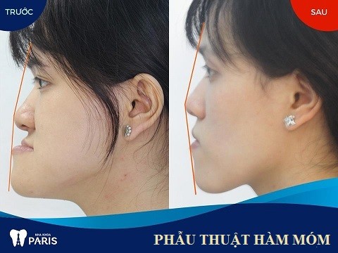 Cần biết - Hàm răng xấu đang hủy hoại tương lai của bạn như thế nào? (Hình 5).