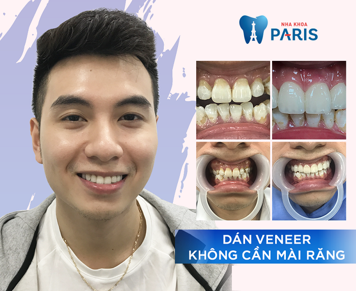 Cần biết - Dán sứ Veneer - Giải pháp hoàn hảo cho hàm răng sáng đẹp (Hình 4).