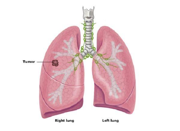 Cần biết -  Bệnh ung thư phổi có mấy loại, mấy giai đoạn? (Hình 2).