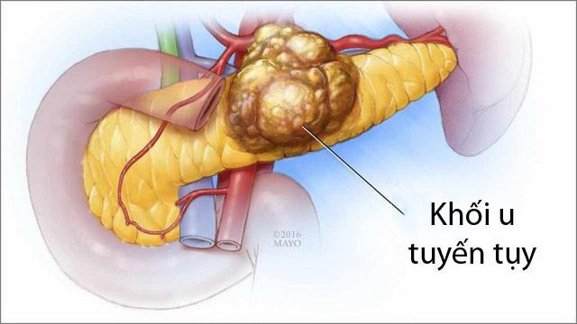 Cần biết - Có nên đi tầm soát ung thư tuyến tụy không? Tầm soát ở đâu?