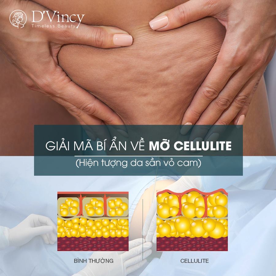 Cần biết - Xóa tan ám ảnh da sần vỏ cam sau hút mỡ tại D’vincy