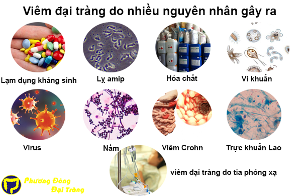 Cần biết - Bệnh viêm đại tràng có thể chữa khỏi được không?