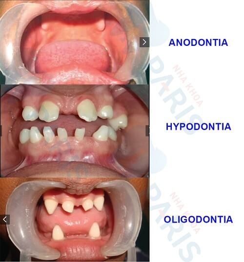Cần biết - Răng không mọc được toàn hàm là bệnh gì? Chữa như thế nào?