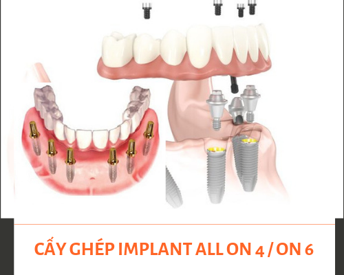 Cần biết - Răng không mọc được toàn hàm là bệnh gì? Chữa như thế nào? (Hình 4).