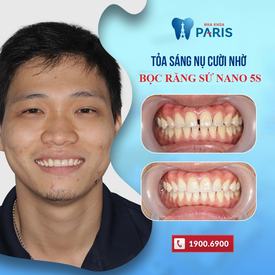 Cần biết - Đâu là giải pháp chỉnh sửa răng thưa cho hiệu quả hoàn mỹ? (Hình 3).