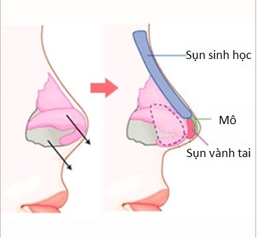 Cần biết - 5 lầm tưởng về nâng mũi bọc sụn ai cũng gặp phải