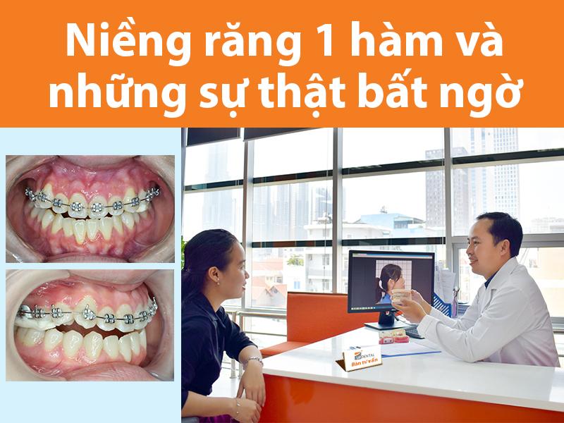 Cần biết - Niềng răng 1 hàm và những sự thật bất ngờ bạn nên biết