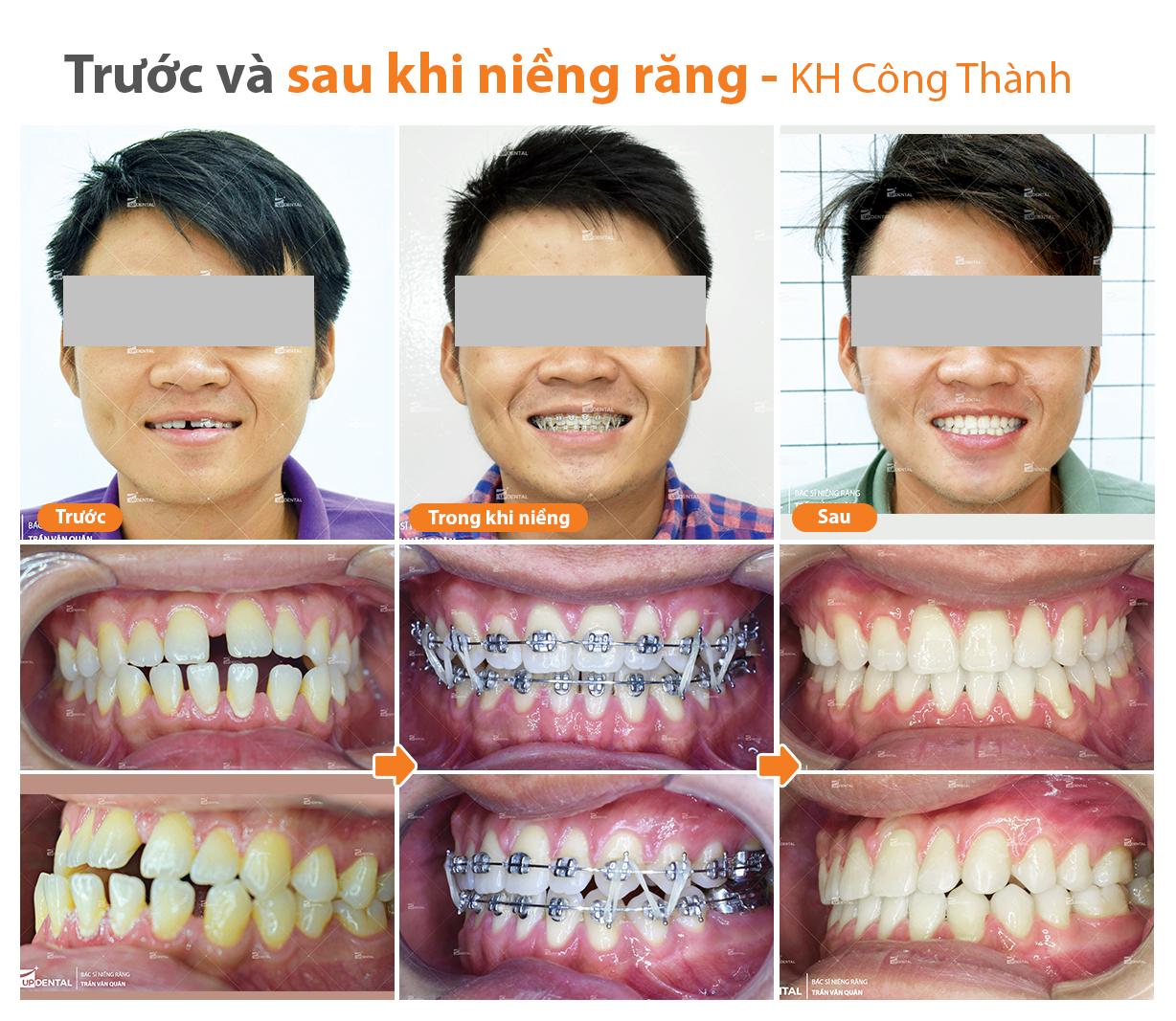 Cần biết - Niềng răng 1 hàm và những sự thật bất ngờ bạn nên biết (Hình 4).