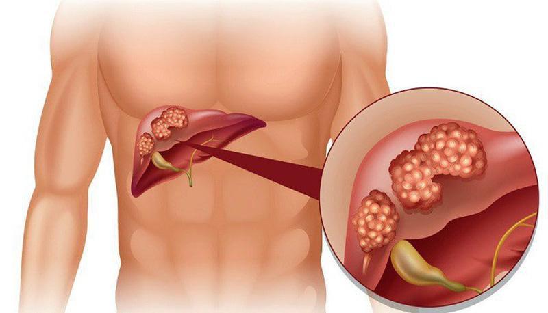 Cần biết - Dấu hiệu nhận biết 9 loại bệnh ung thư phổ biến hiện nay