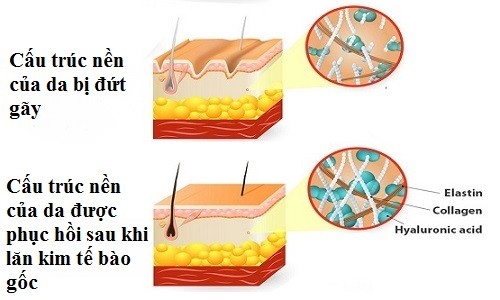 Cần biết - Những sự thật về công nghệ lăn kim tế bào gốc khiến bạn bất ngờ (Hình 3).