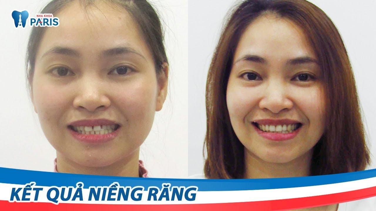 Cần biết - Niềng răng năm 30 tuổi, tại sao không? (Hình 4).